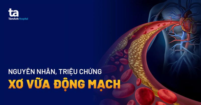 Minh họa một số bệnh lý mạch máu chi dưới thường gặp như suy giãn tĩnh mạch và xơ vữa động mạch, cho thấy sự khác biệt giữa mạch máu khỏe mạnh và mạch máu bị bệnh