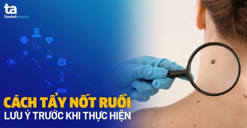 Các phương pháp xóa nốt ruồi son trên ngực