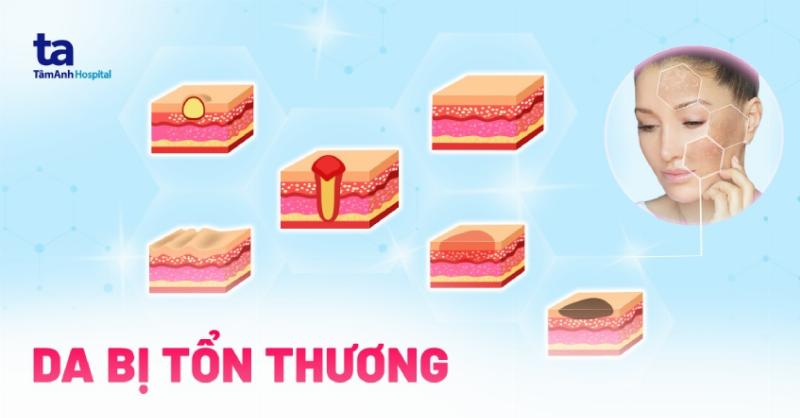 Hinh anh minh hoa giac mo bi cho can gay chay mau bieu tuong ton thuong sau sac