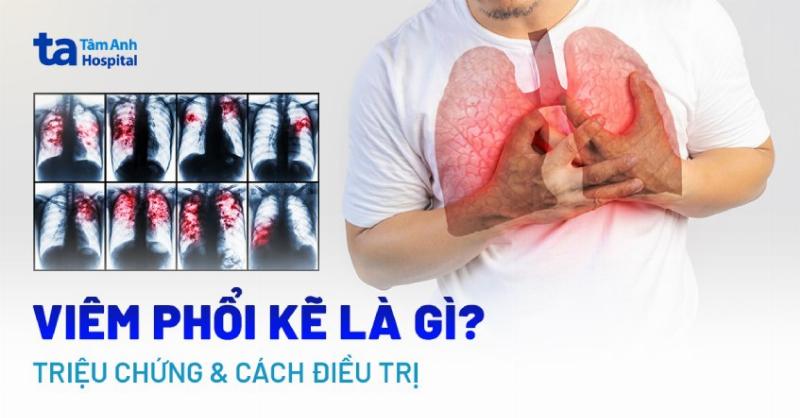 Hinh anh X-quang phoi the hien chuan doan viem phoi