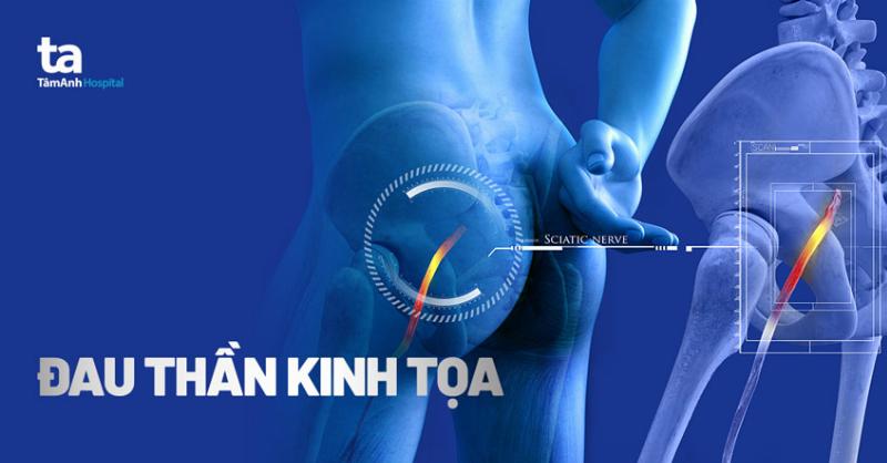 hinh-anh-minh-hoa-trieu-chung-dau-than-kinh-toa