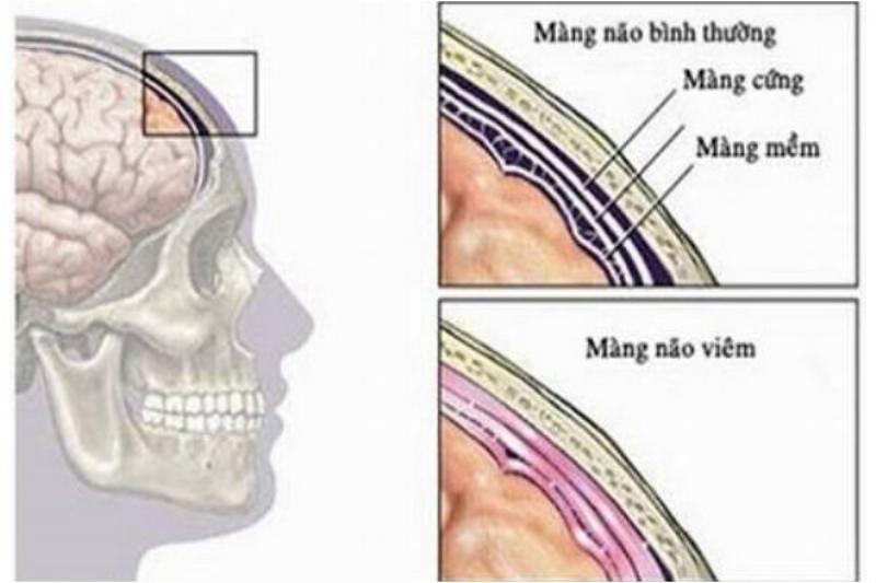 trieu-chung-hoi-chung-nao-mang-nao