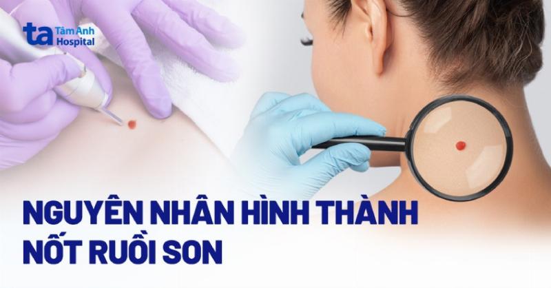 Khi nào cần đi khám bác sĩ về nốt ruồi son?