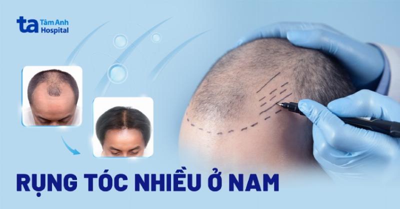 Lông mày gián đoạn ở đàn ông: Những điều cần biết