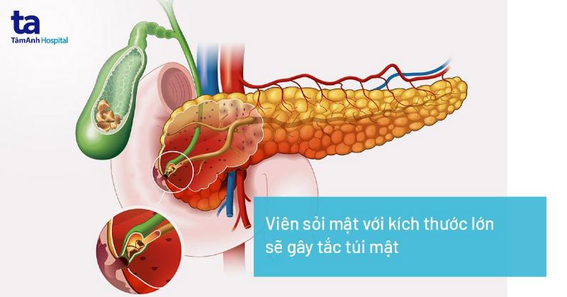 Hình ảnh minh họa sỏi mật gây tắc nghẽn ống tụy, một nguyên nhân điển hình của viêm tụy cấp