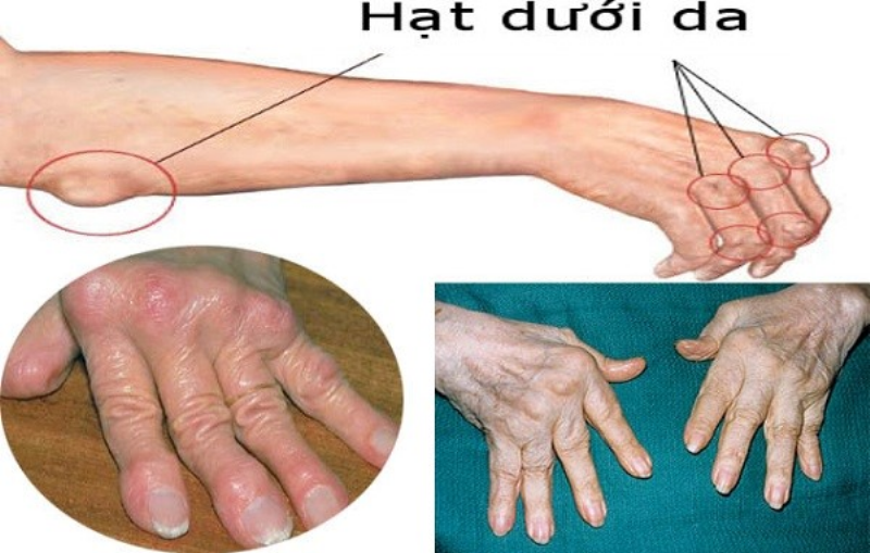 Hình ảnh minh họa vai trò trung tâm của bệnh án trong quản lý bệnh mãn tính như viêm khớp dạng thấp, kết nối các lần khám và điều trị