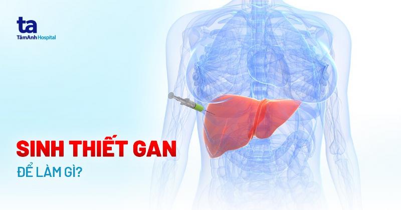 Hinh anh quy trinh sinh thiet gan de chan doan hoi chung suy te bao gan