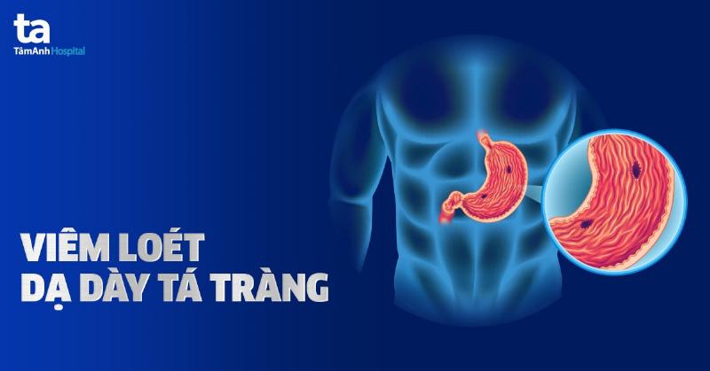 ảnh minh họa nguyên nhân viêm loét dạ dày tá tràng
